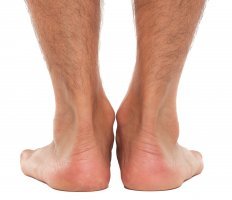 flat feet