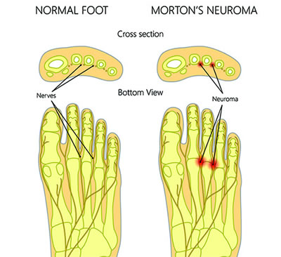 neuroma