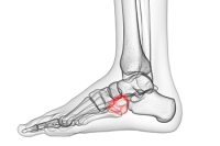 How to Recognize Cuboid Syndrome