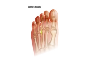 Morton&#039;s Neuroma and How to Find Relief
