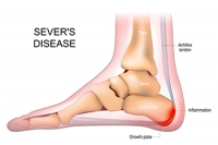 Definition and Risk Factors of Sever’s Disease