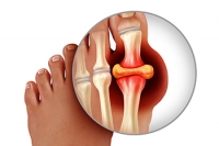 Types and Risk Factors of Gout