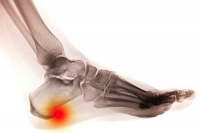 Definition and Common Symptoms of Heel Spurs