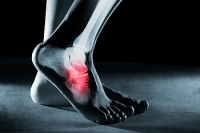 Causes of Foot Stress Fractures