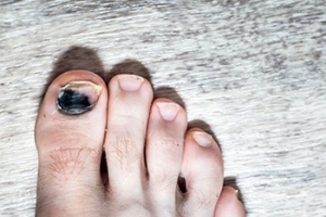 When Toenails Turn Black