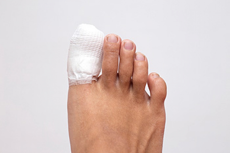 Broken Toe: Causes, Symptoms, and Treatment - wide 2