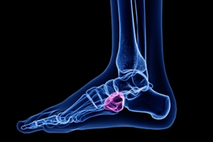 Diagnosing Cuboid Syndrome in Athletes