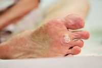 Walking May Be Affected by a Plantar Wart