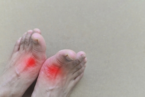 Understanding the Causes and Symptoms of Gout