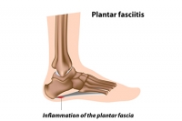 Hydrotherapy and Plantar Fasciitis