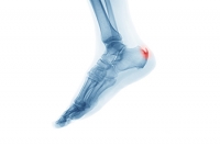 Definition and Location of Heel Spurs