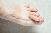 Causes of Hammertoe and Vulnerable Individuals
