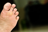 Understanding Plantar Warts and When Removal Is Needed